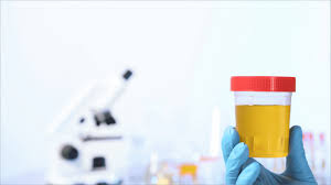 Urinálisis y Microscopía Clinica